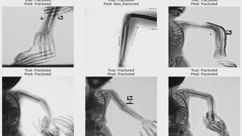 AI-Based Applied Innovation for Fracture Detection in X-rays Using Custom CNN and Transfer Learning Models
