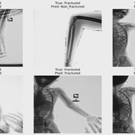 AI-Based Applied Innovation for Fracture Detection in X-rays Using Custom CNN and Transfer Learning Models
